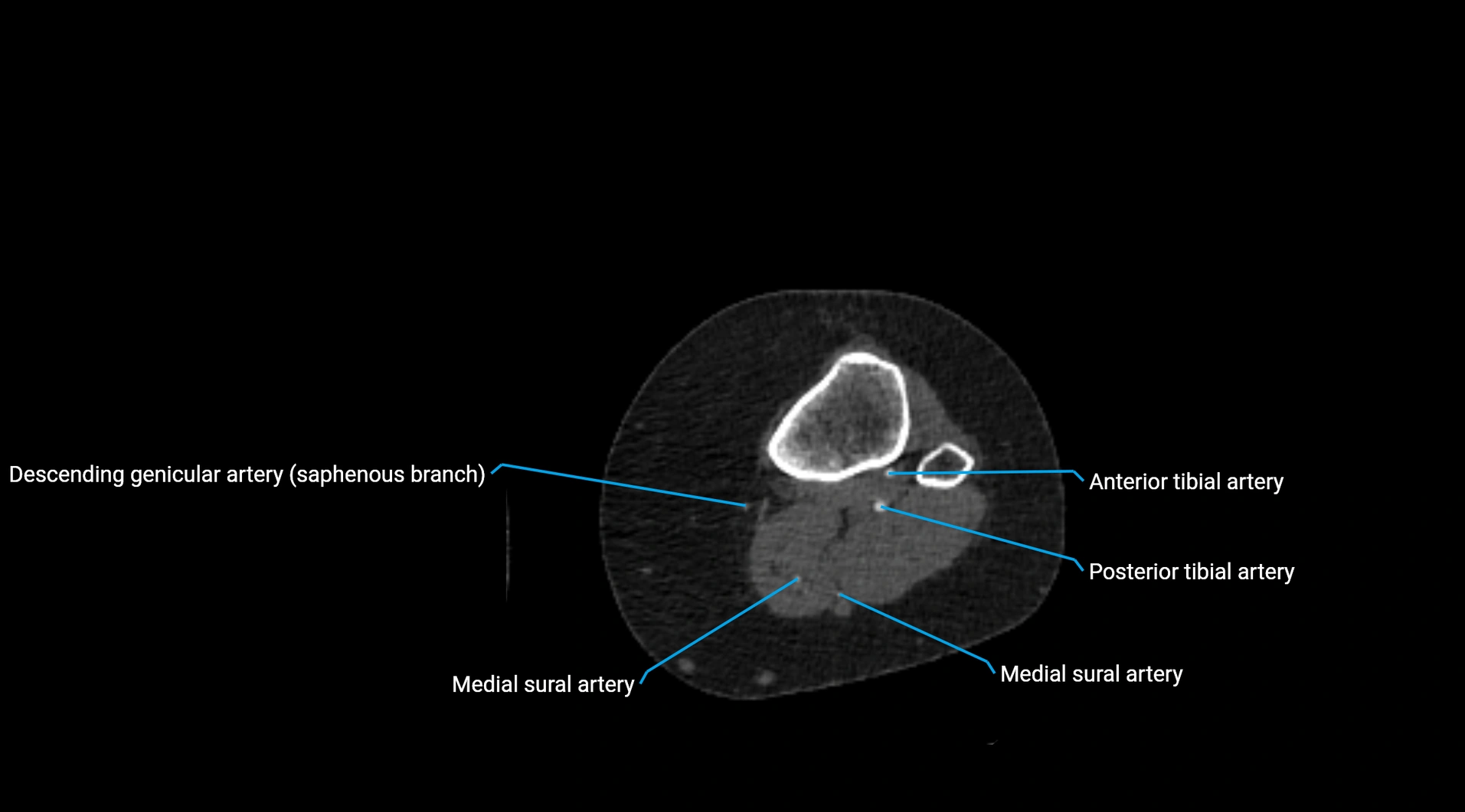 CTA lower limb cross sectional anatomy labelled image _184.webp